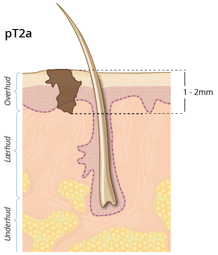 ©kreftlex.no, melanoma, føflekkreft, stadie, pT2a