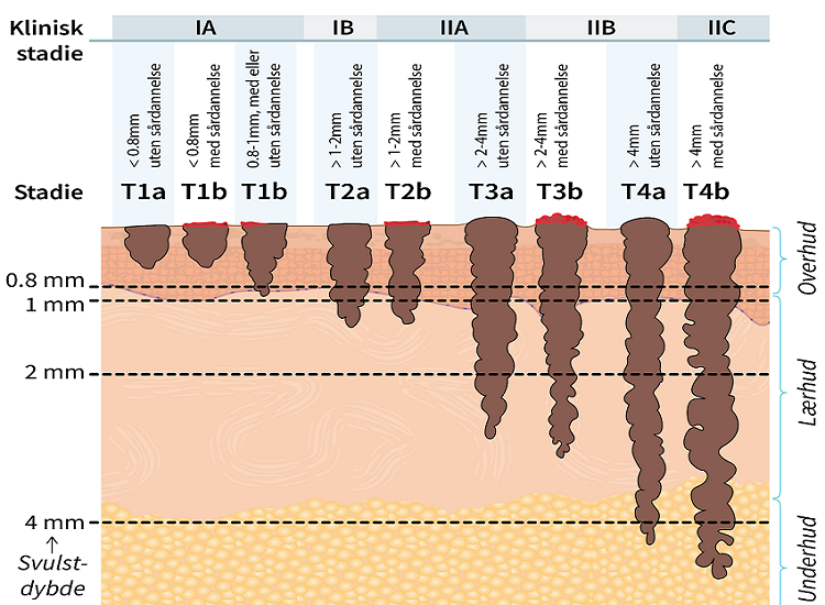 Stadieinndeling, lokal svulst_melanom