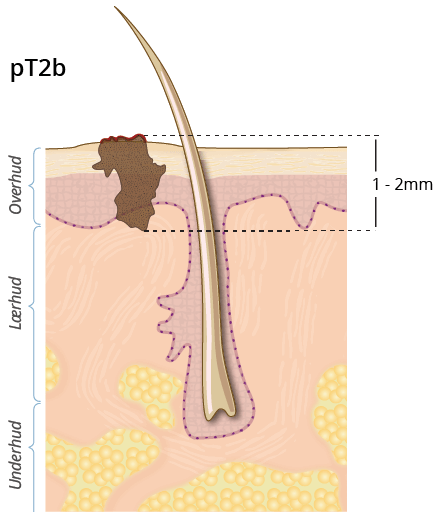 ©kreftlex.no, melanoma, føflekkreft, stadie, pT2b