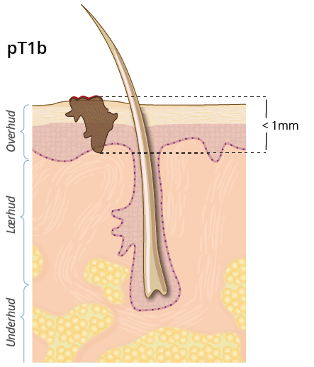 ©kreftlex.no, melanoma, føflekkreft, stadie, pT1b