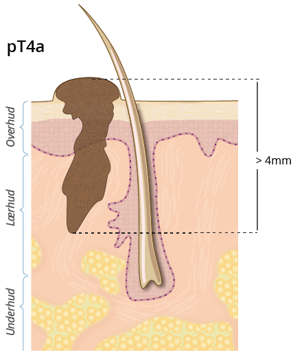 ©kreftlex.no, melanoma, føflekkreft, stadie, pT4a