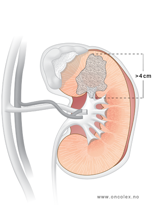 Illustrasjon, stadieinndeling ved kreft i nyrene. T1b.