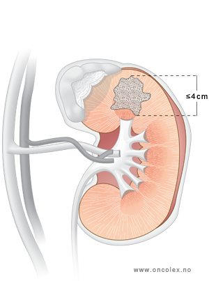 Illustrasjon, stadieinndeling ved kreft i nyrene. T1a