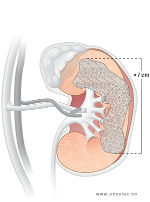 Illustrasjon, stadieinndeling ved kreft i nyrene. T2.