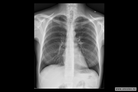 Bilde av røntgen toraks