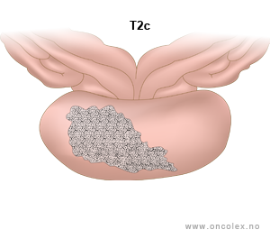 Illustrasjon, stadieinndeling av prostatakreft. T2c.