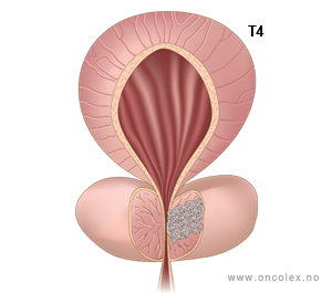Illustrasjon, stadieinndeling av prostatakreft. T4.