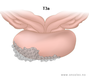 Illustrasjon, stadieinndeling av prostatakreft. T3a.