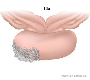Illustrasjon, stadieinndeling av prostatakreft. T3a.