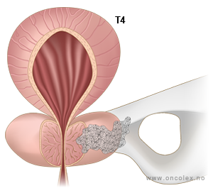 Illustrasjon, stadieinndeling av prostatakreft. T4.