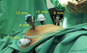 Kirurgisk fjerning av prostata, foto fra operasjon