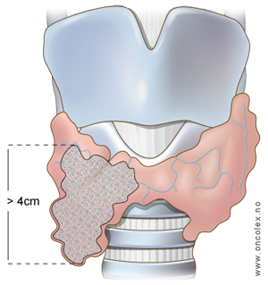 Illustrasjon, stadieinndeling av kreft i skjoldbruskkjertel. pT3.