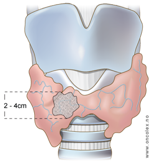 Illustrasjon, stadieinndeling av kreft i skjoldbruskkjertel. pT2.