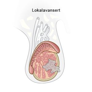 Illustrasjon, stadieinndeling av testikkelkreft.