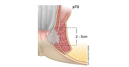 Analkreft, stadie II